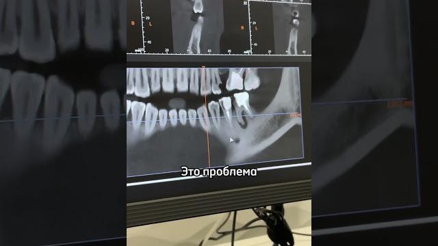 УЖАСНО красиво КИСТА зуба!...Они видны ТОЛЬКО на КТ. УЖАСНО красиво КИСТА зуба!...Они видны ТОЛЬКО на КТ.