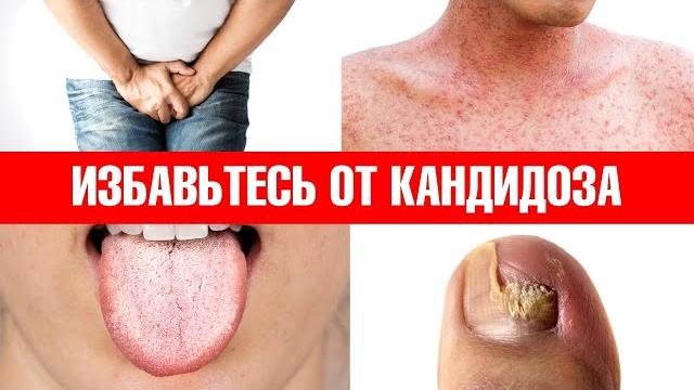 Примените эти 6 средств, и кандидоз никогда не вернется Примените эти 6 средств, и кандидоз никогда не вернется