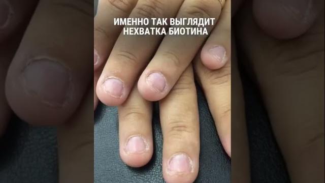 Как влияет биотин на красоту #биотин #витамины #диетолог #волосы #лицоуход #морщины #ногти Как влияет биотин на красоту #биотин #витамины #диетолог #волосы #лицоуход #морщины #ногти