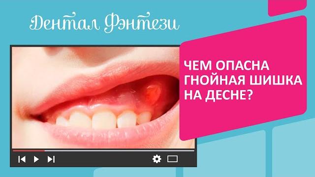 Чем опасна гнойная шишка на десне Чем опасна гнойная шишка на десне