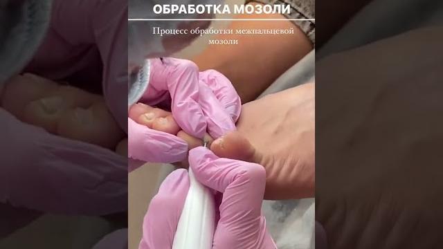 Мозоль между пальцев Мозоль между пальцев