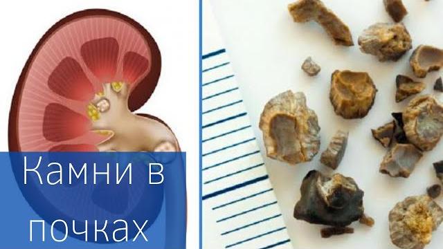 КАМНИ В ПОЧКАХ | Как лечить? | Профилактика КАМНИ В ПОЧКАХ | Как лечить? | Профилактика