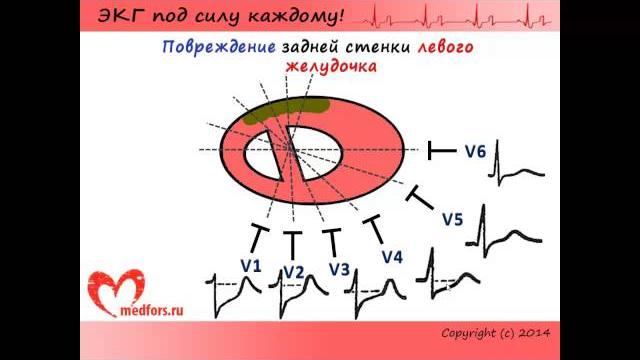Урок 10. Видеокурс "ЭКГ под силу каждому" + КНИГА!!! Урок 10. Видеокурс "ЭКГ под силу каждому" + КНИГА!!!