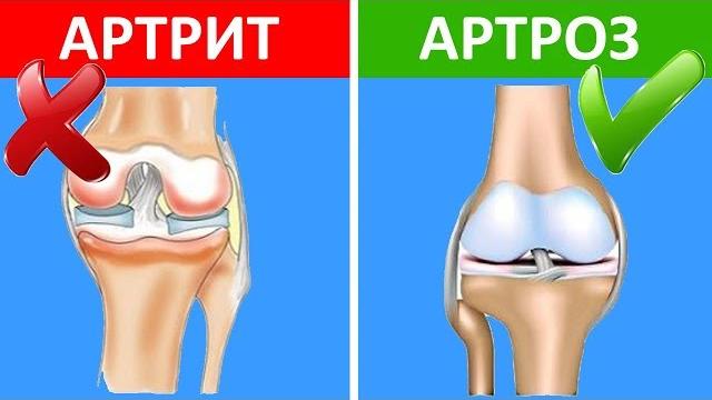 Чем отличается артрит от артроза? Чем отличается артрит от артроза?