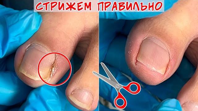 Ingrown toenails / Nail prone to ingrowth Ingrown toenails / Nail prone to ingrowth