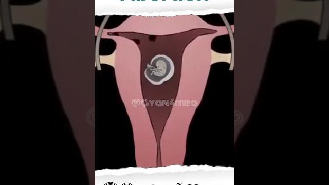 Abortion Animation Abortion Animation