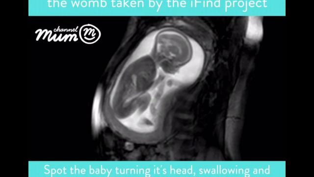 MRI Scan Video of Baby Moving in Womb | Channel Mum MRI Scan Video of Baby Moving in Womb | Channel Mum