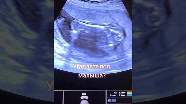 Определение пола ребёнка на УЗИ Определение пола ребёнка на УЗИ