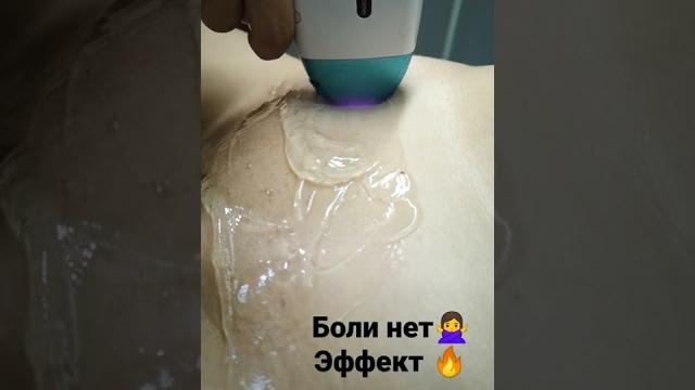лазерная эпиляция бикини лазерная эпиляция бикини