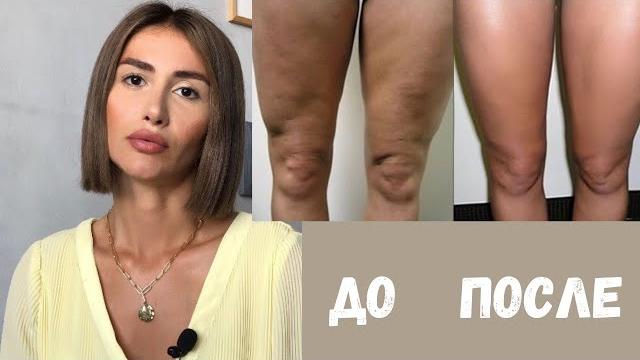 КАК ИЗБАВИТЬСЯ ОТ ЦЕЛЛЮЛИТА? МОЙ ОПЫТ КАК ИЗБАВИТЬСЯ ОТ ЦЕЛЛЮЛИТА? МОЙ ОПЫТ