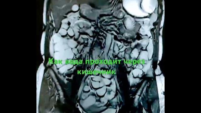 Что видно в кишечнике на МРТ#shorts Что видно в кишечнике на МРТ#shorts