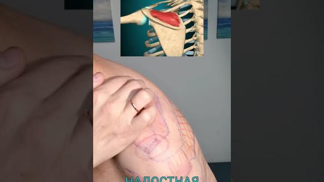 ЧТО БОЛИТ В ПЛЕЧЕ? ДИАГНОСТИКА ЗА 1 МИНУТУ. АРОРОЗ. ИМПИДЖМЕНТ СИНДРОМ. ТРАВМА СУХОЖИЛИЯ. ЧТО БОЛИТ В ПЛЕЧЕ? ДИАГНОСТИКА ЗА 1 МИНУТУ. АРОРОЗ. ИМПИДЖМЕНТ СИНДРОМ. ТРАВМА СУХОЖИЛИЯ.