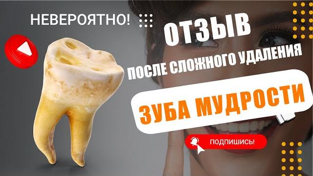 Отзыв после сложного удаления зуба мудрости. Удаление зуба мудрости - процедура в стоматологии. Отзыв после сложного удаления зуба мудрости. Удаление зуба мудрости - процедура в стоматологии.