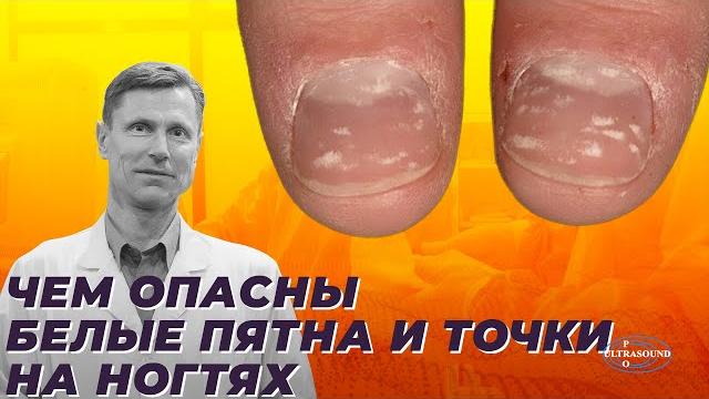 Чем опасны белые пятна и точки на ногтях. Чем опасны белые пятна и точки на ногтях.