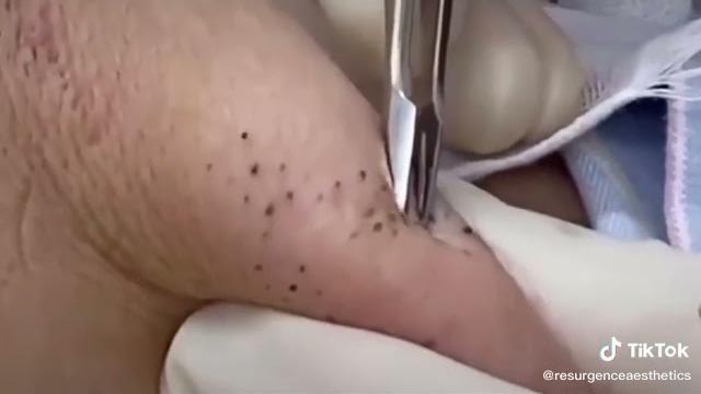 Черные точки и милиумы, большие кистозные угри Удаление черных точек Удаление белых точек Черные точки и милиумы, большие кистозные угри Удаление черных точек Удаление белых точек