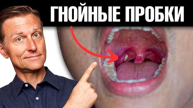 Как избавиться от гнойных пробок в горле навсегда? Как избавиться от гнойных пробок в горле навсегда?