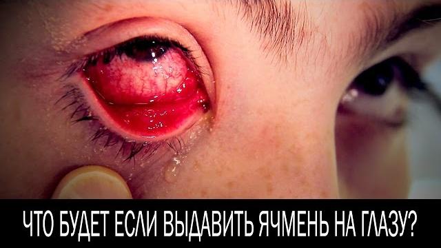 Что будет если выдавить ячмень на глазу Что будет если выдавить ячмень на глазу