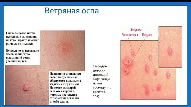 Оспа обезьян Оспа обезьян