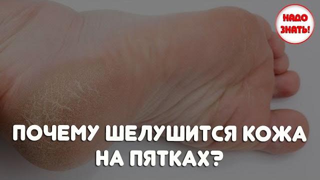 Почему шелушится кожа на пятках? Почему шелушится кожа на пятках?