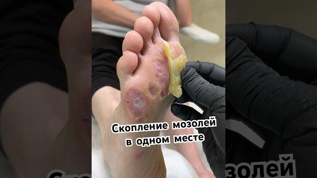 Россыпи стержневых мозолей в одном месте | стала чувствовать свои ноги #мозоли #подологмосква Россыпи стержневых мозолей в одном месте | стала чувствовать свои ноги #мозоли #подологмосква