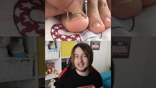 Самое необычное устройство для вросших ногтей! Самое необычное устройство для вросших ногтей!