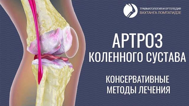 Артроз коленного сустава. Консервативные методы лечения Артроз коленного сустава. Консервативные методы лечения
