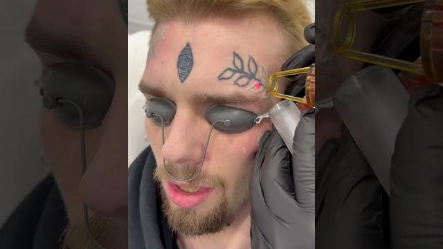 Удаляем тату с лица в клинике Sokolov Laser Удаляем тату с лица в клинике Sokolov Laser