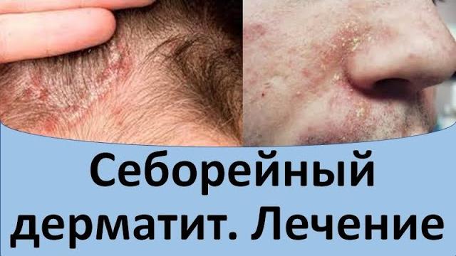 Себорейный дерматит лечение. Себорейный дерматит лечение.