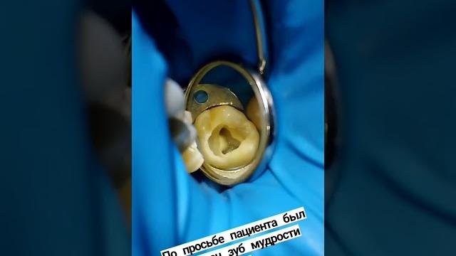 лечение зуба мудрости!! лечение зуба мудрости!!