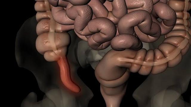 Аппендицит. Как и почему он появляется Аппендицит. Как и почему он появляется