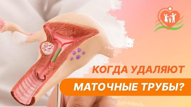 Когда удаляют маточные трубы? Когда удаляют маточные трубы?