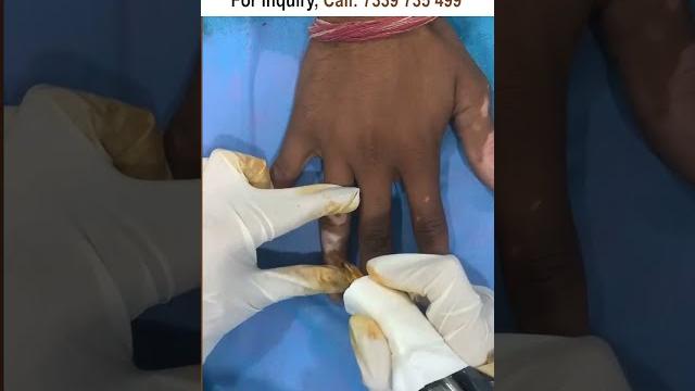 Vitiligo treatment at skinaa clinic #vitiligomodel #vitiligo #shorts #viralshorts #skinaaclinic Vitiligo treatment at skinaa clinic #vitiligomodel #vitiligo #shorts #viralshorts #skinaaclinic