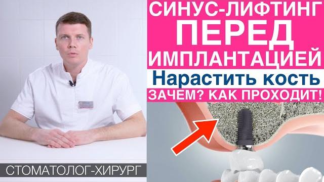 Синус-лифтинг - наращивание костной ткани перед имплантацией зубов. Установка зубных имплантов. Синус-лифтинг - наращивание костной ткани перед имплантацией зубов. Установка зубных имплантов.