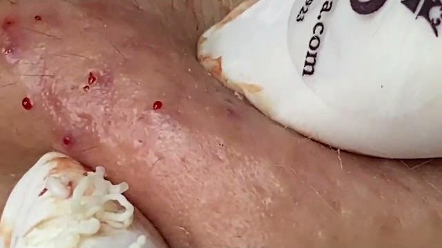 LARGE Blackheads Removal Best Pimple Popper Trippers Videos выдавливание БОЛЬШИХ Угрей Прыщи LARGE Blackheads Removal Best Pimple Popper Trippers Videos выдавливание БОЛЬШИХ Угрей Прыщи