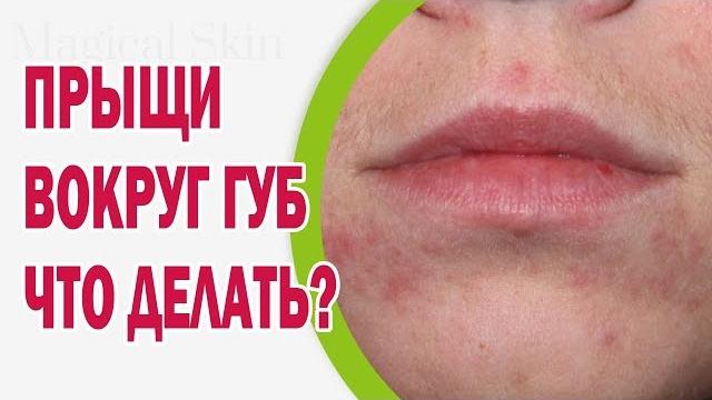 Что делать, если появились прыщи вокруг губ Что делать, если появились прыщи вокруг губ