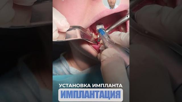 Установка импланта. Implant installation. Установка импланта. Implant installation.