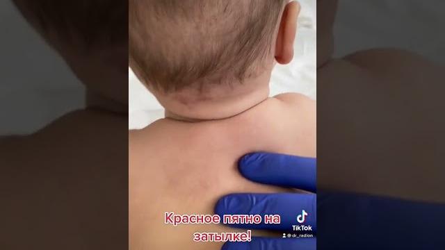 Красное пятно на затылке у грудничка. Красное пятно на затылке у грудничка.
