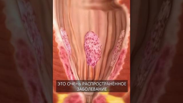 Что такое Геморрой? Что такое Геморрой?