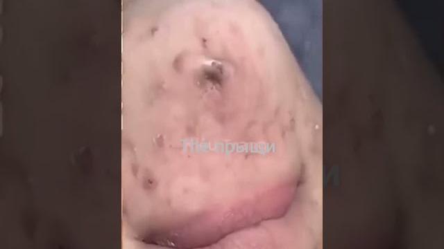 Самое залипательное видео давить прыщи Черные точки Самое залипательное видео давить прыщи Черные точки