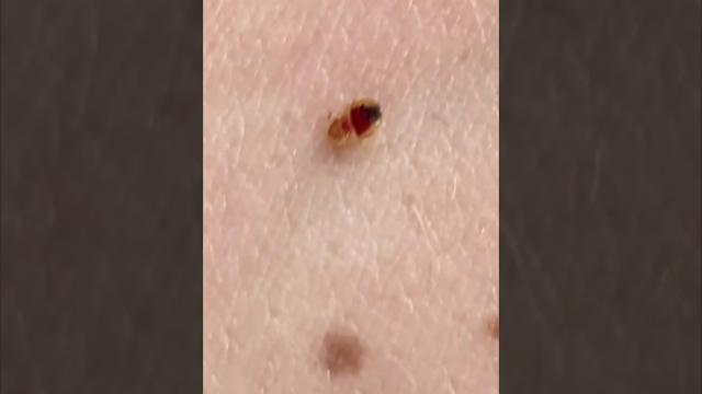Что делать при укусе постельного клопа. Последствия укуса Что делать при укусе постельного клопа. Последствия укуса