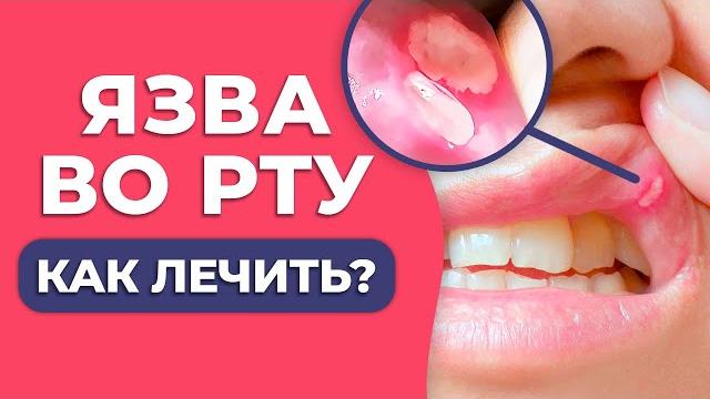 Как вылечить ЯЗВУ ВО РТУ? / Афта: причины появления Как вылечить ЯЗВУ ВО РТУ? / Афта: причины появления