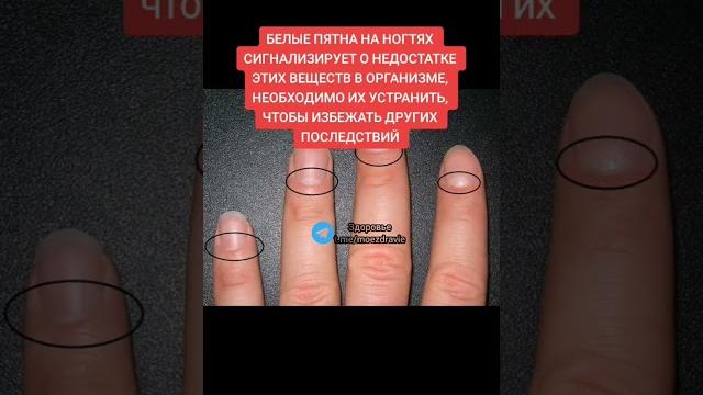 белые пятна на ногтях сигнализирует о недостатке этих веществ... #народнаямедицина #здоровье #зож белые пятна на ногтях сигнализирует о недостатке этих веществ... #народнаямедицина #здоровье #зож