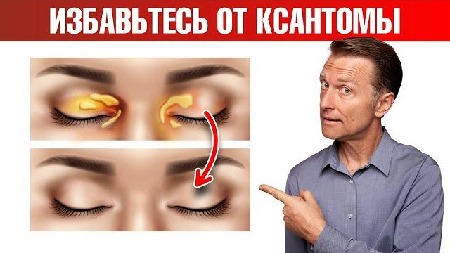 Как избавиться от ксантомы век в домашних условиях? Как избавиться от ксантомы век в домашних условиях?