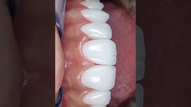 Керамические Виниры #odessa #blonde #ukraine #dentist #виниры #приколы #beauty #рекомендации Керамические Виниры #odessa #blonde #ukraine #dentist #виниры #приколы #beauty #рекомендации
