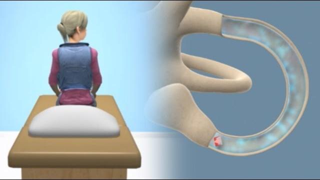 Epley Maneuver для лечения головокружения BPPV Epley Maneuver для лечения головокружения BPPV