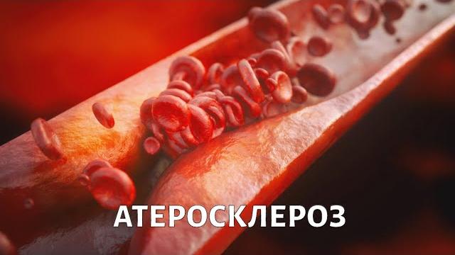 Доктор БОКЕРИЯ. Кому грозит атеросклероз? Доктор БОКЕРИЯ. Кому грозит атеросклероз?