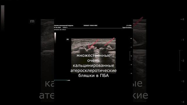 каменные бляшки#атеросклероз каменные бляшки#атеросклероз
