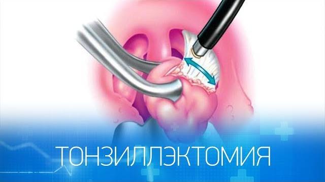 Лазерное удаление небных миндалин – что это такое? Лазерное удаление небных миндалин – что это такое?