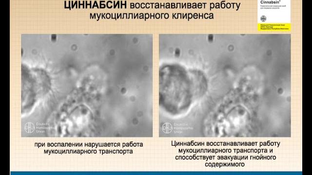 Состояние мукоцилиарного транспорта на фоне применения препарата Циннабсин (данные эндомикроскопии) Состояние мукоцилиарного транспорта на фоне применения препарата Циннабсин (данные эндомикроскопии)