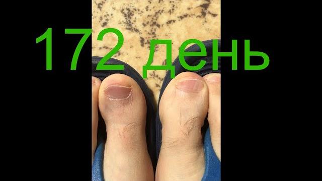 ЛЕЧЕНИЕ НОГ ОТ ГРИБКА 172 ДЕНЬ ЛЕЧЕНИЕ НОГ ОТ ГРИБКА 172 ДЕНЬ